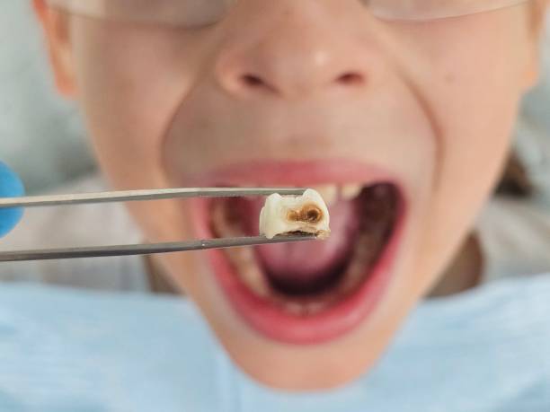 Best Emergency Wisdom Teeth Removal in Montebello, CA