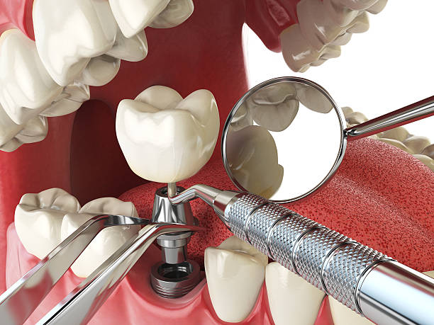 Best Emergency Denture Repair in Montebello, CA